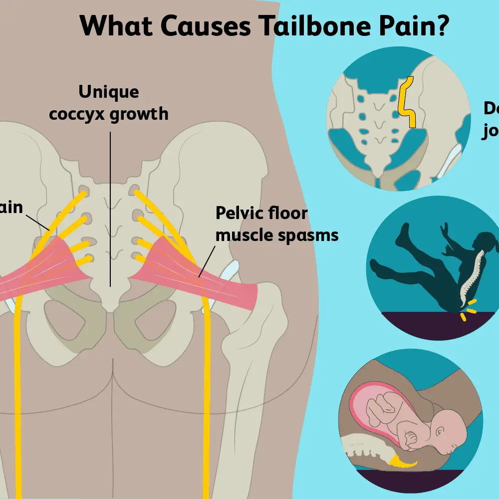 Tailbone pain in women and men