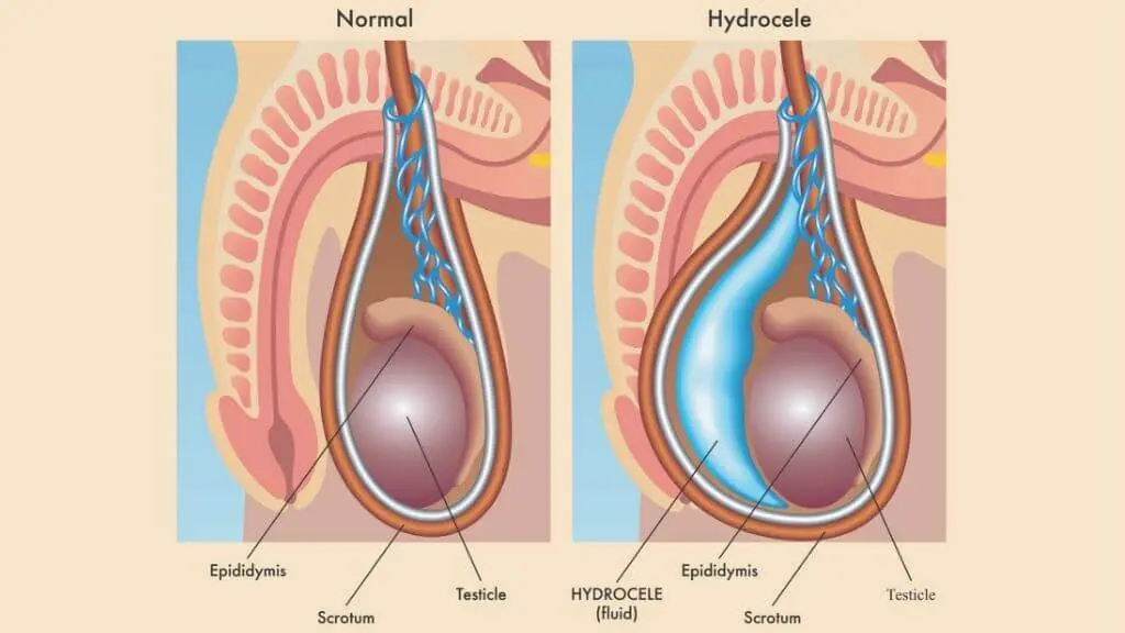 Testicular dropsy in men