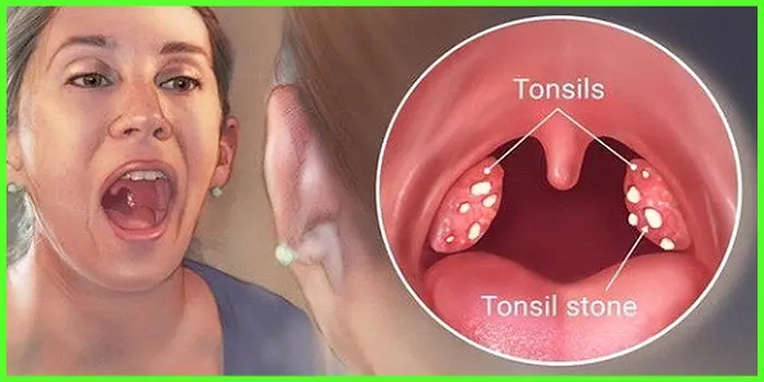 The best remedies for tonsillitis