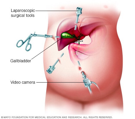 The Best Treatments for Cholecystitis