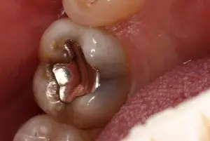 The tooth reacts to cold and hot