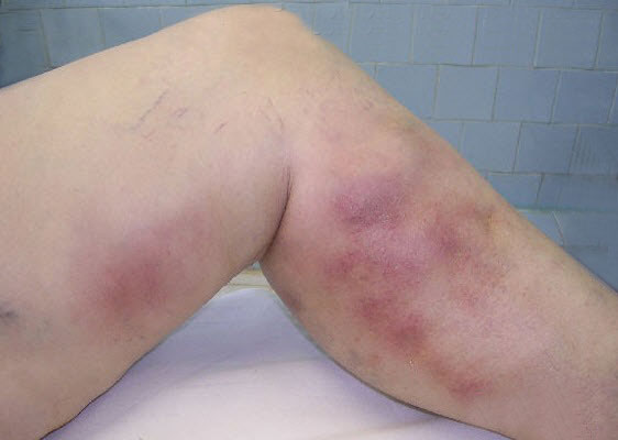 Thrombophlebitis of the lower extremities