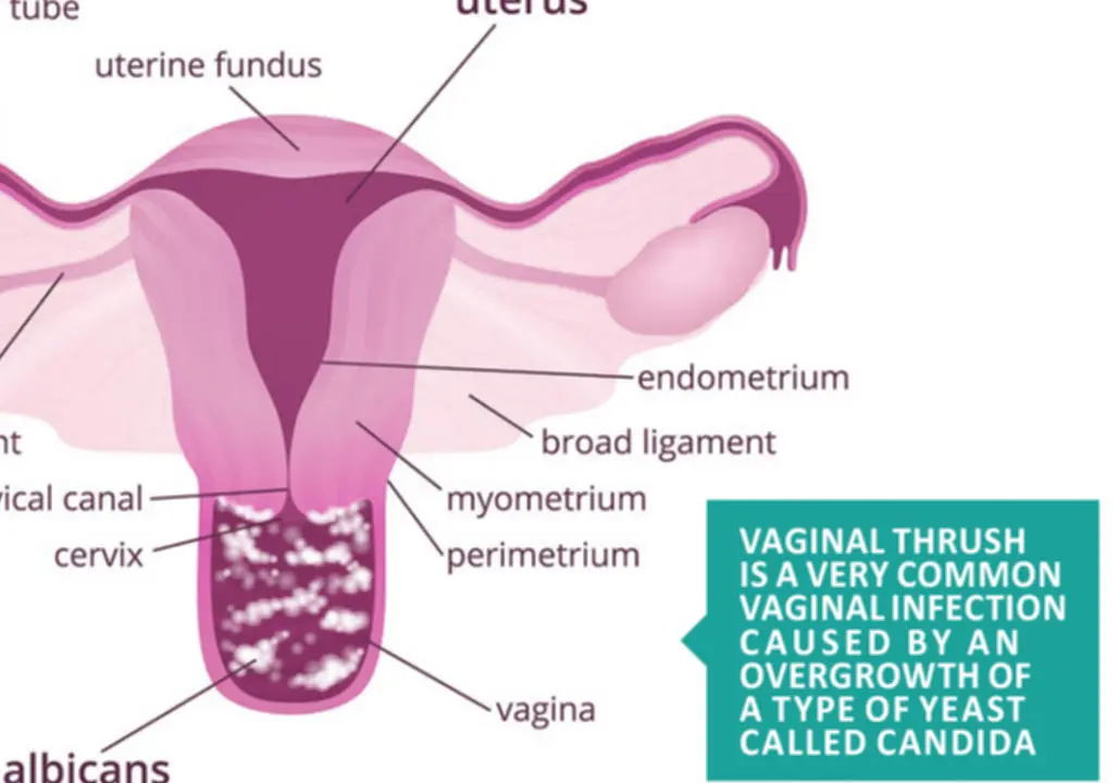 Thrush in women