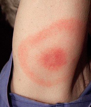 Tick-borne borreliosis