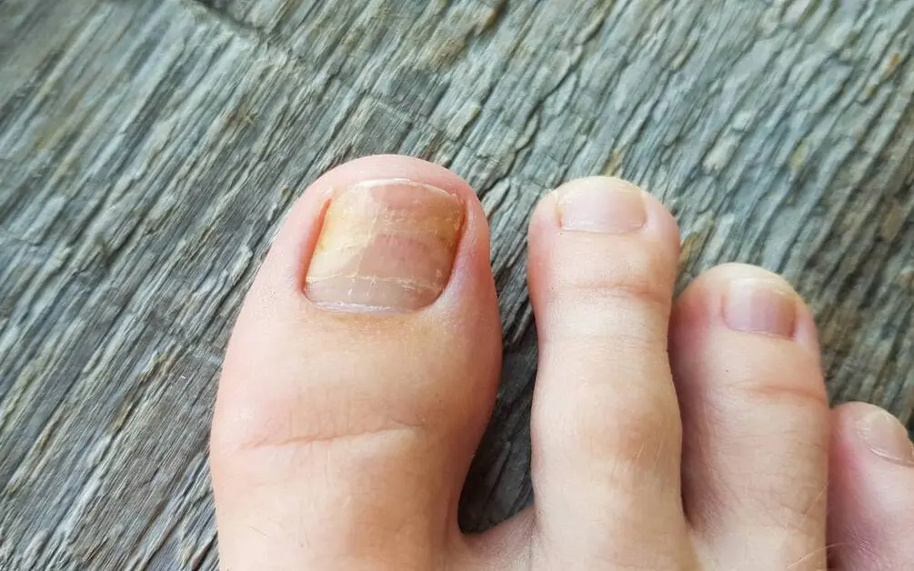 Toenail fungus