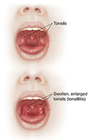 Tonsillitis in adults