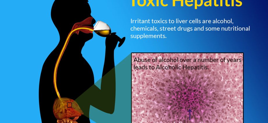 Toxic hepatitis