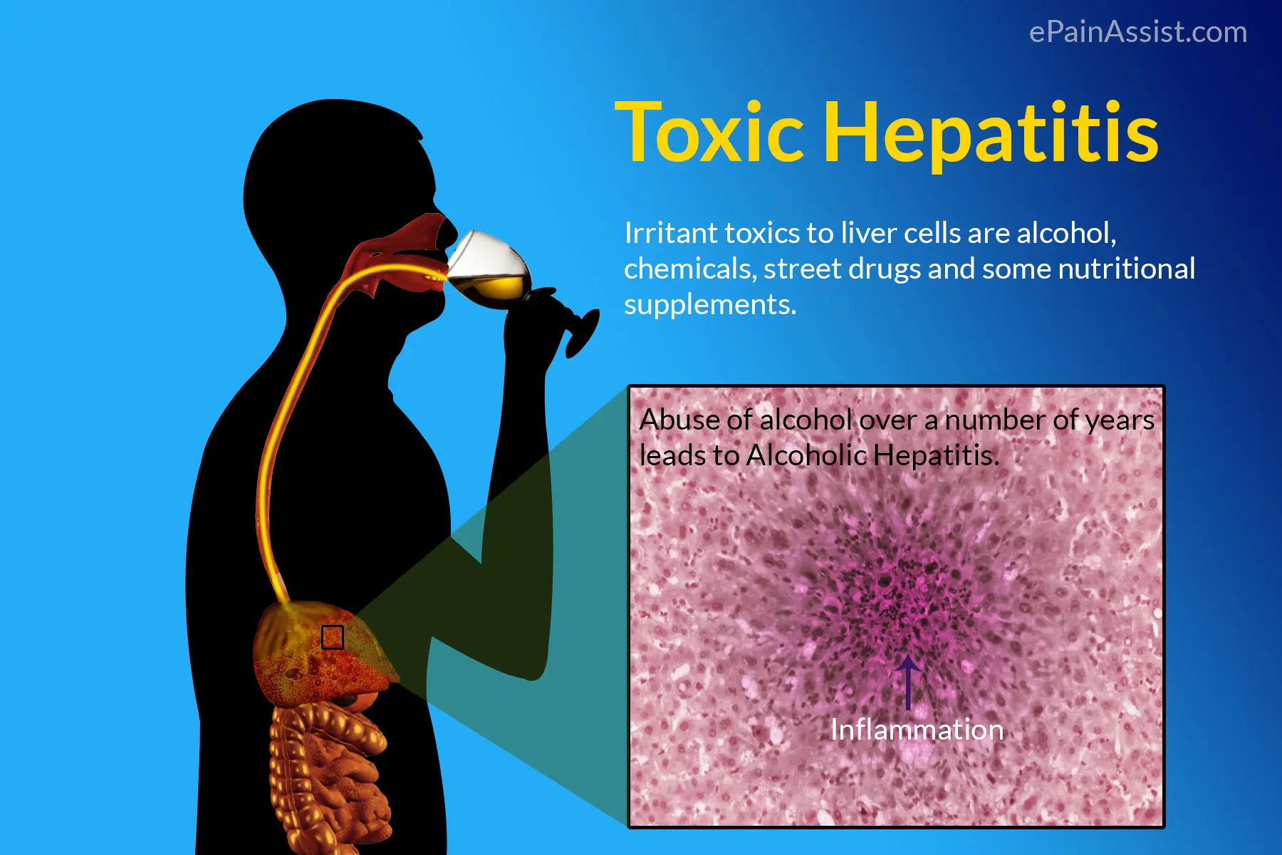 Toxic hepatitis