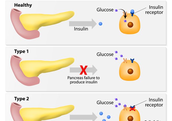 Type 2 diabetes mellitus