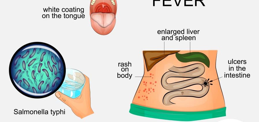 Typhoid fever in adults