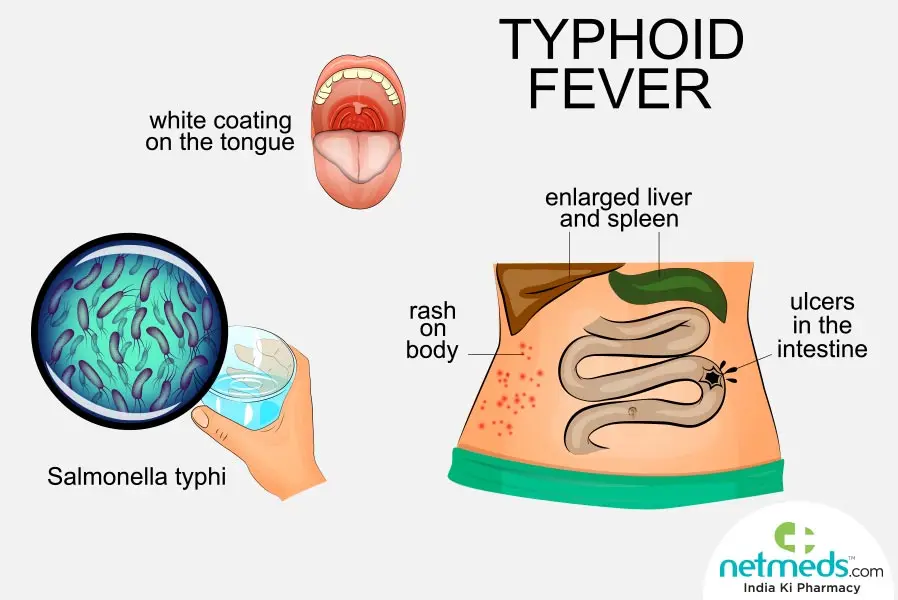 Typhoid fever in adults