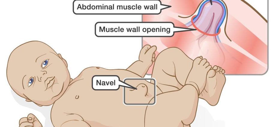 Umbilical hernia in newborns