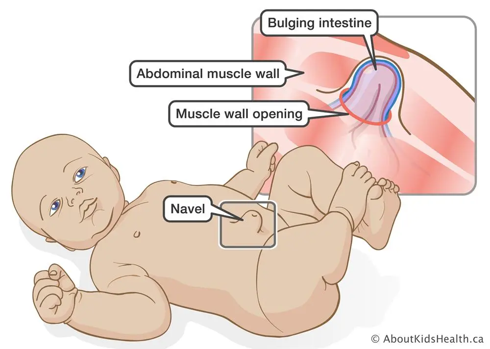 Umbilical hernia in newborns