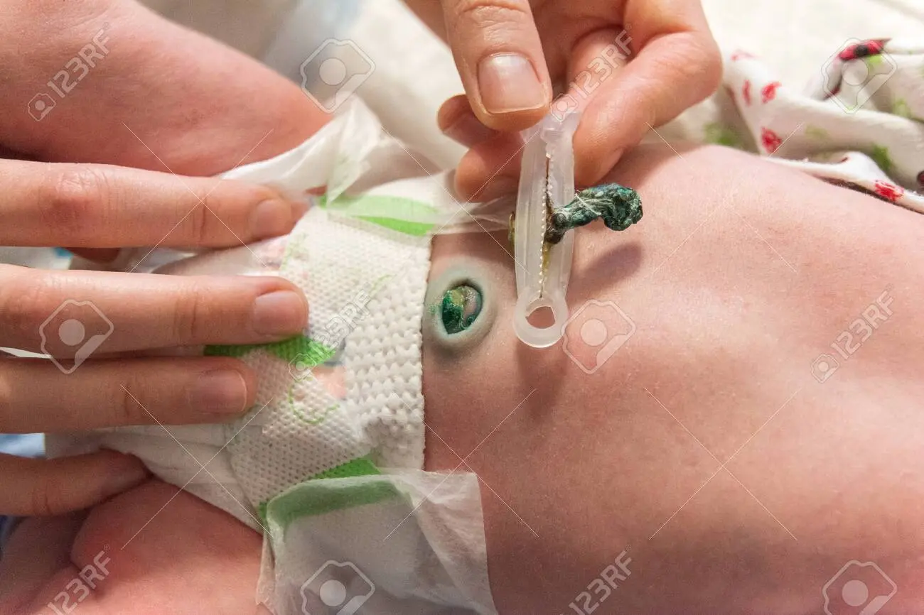 Umbilical wound in a newborn