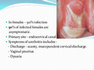 Urethritis in women