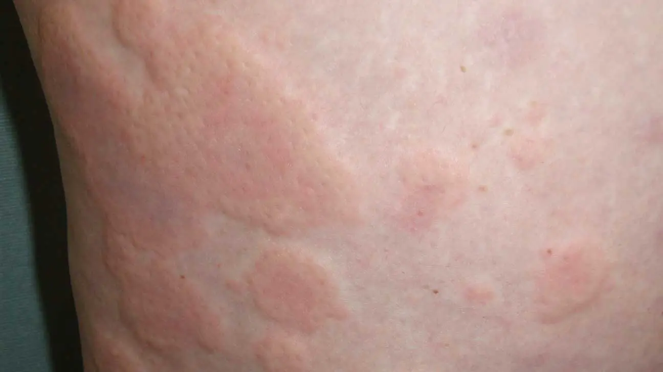 Urticaria in adults