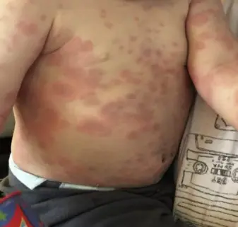 Urticaria in children