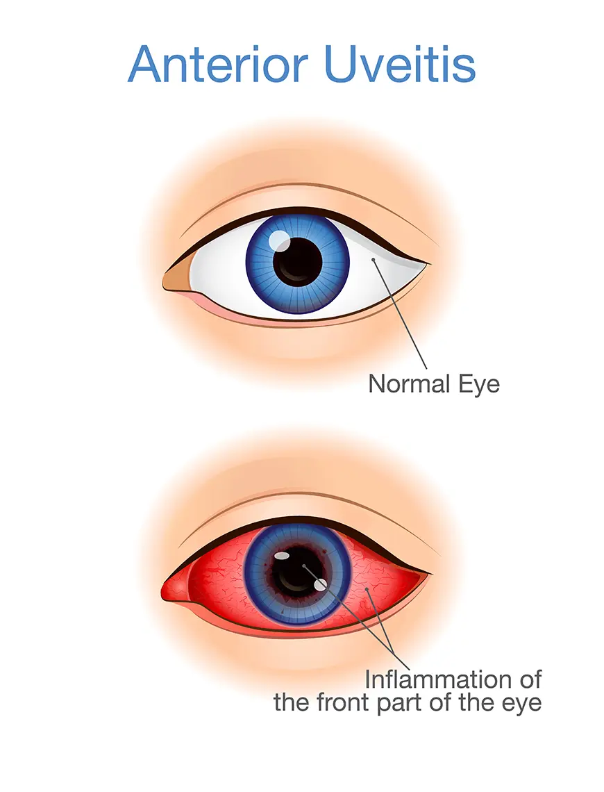 Uveitis in adults