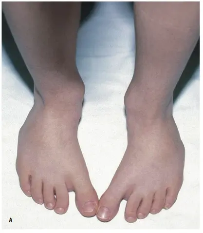 Valgus deformity of the foot in children