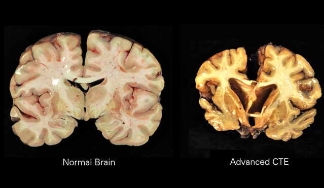 Vascular encephalopathy of the brain in adults