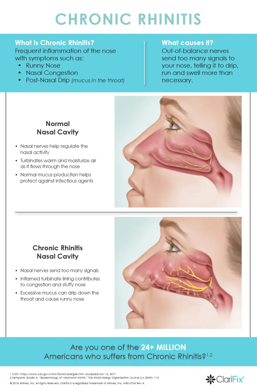 Vasomotor rhinitis