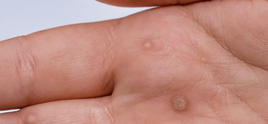 Warts on the hands of adults