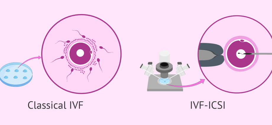 What is IVF ICSI