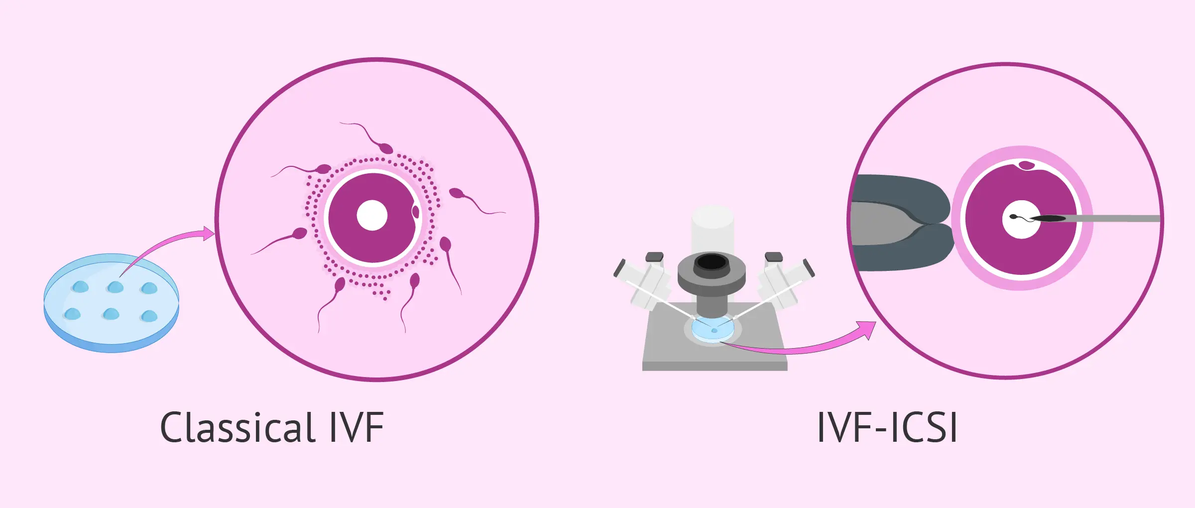 What is IVF ICSI