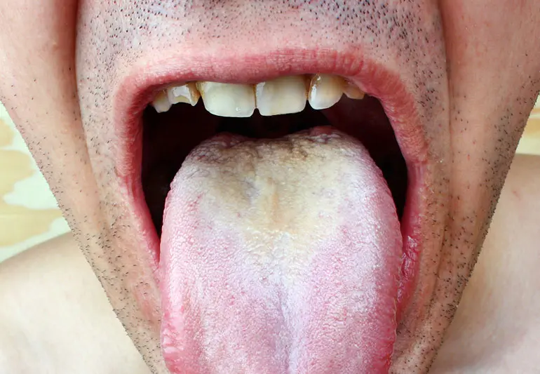 White coating on the tongue in adults