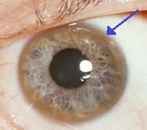 Wilson-Konovalov disease in adults