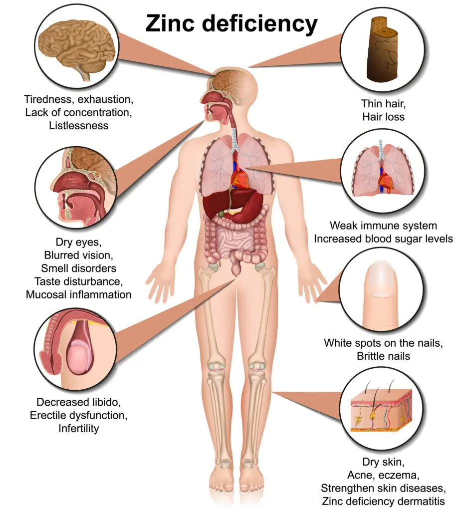 Zinc deficiency in women