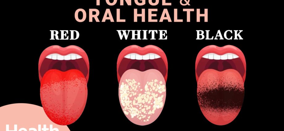 10 diseases that can be seen on the tongue