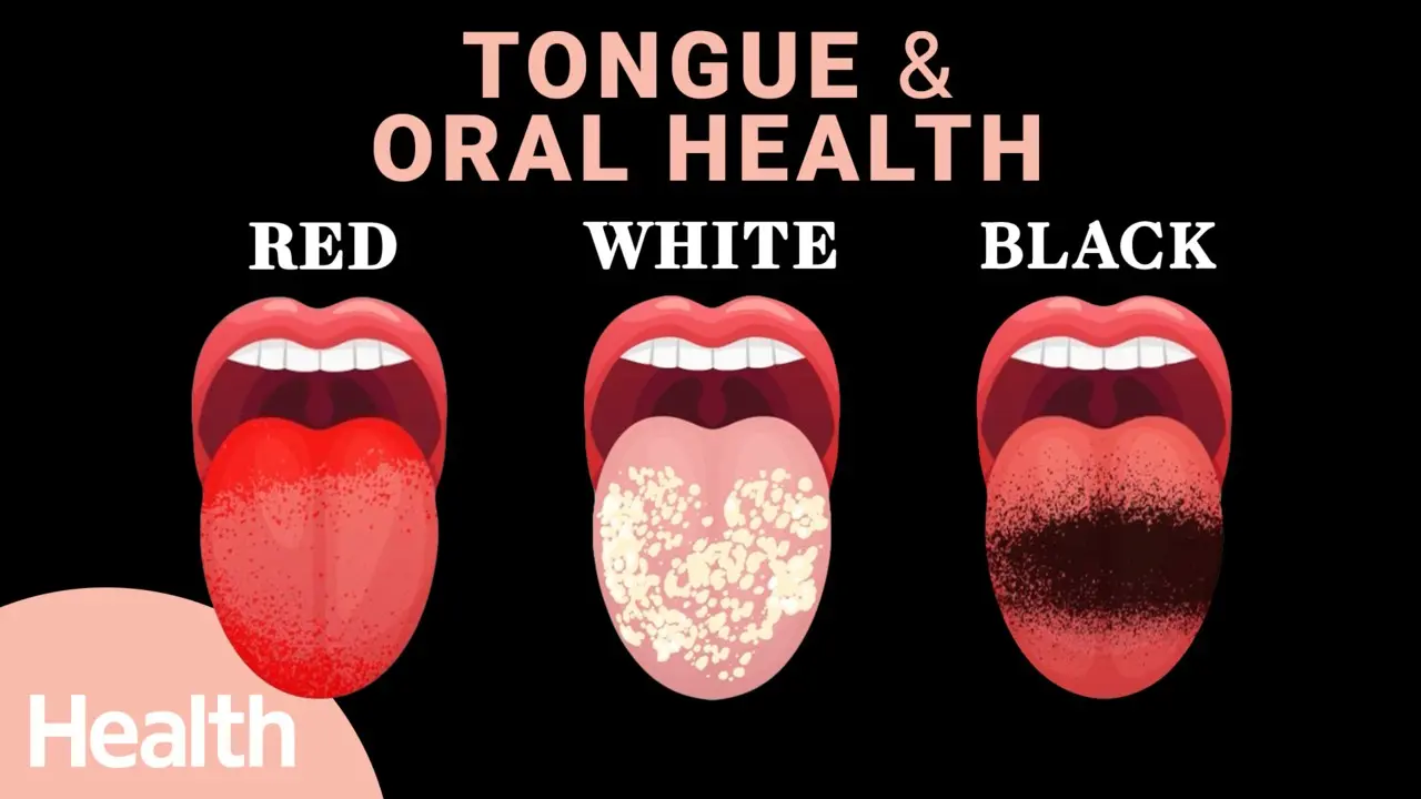 10 diseases that can be seen on the tongue