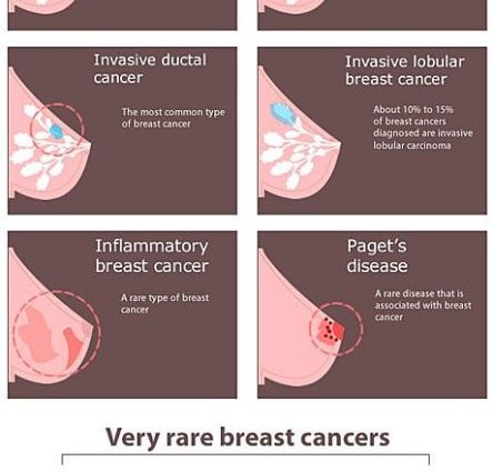 10 types of breast cancer