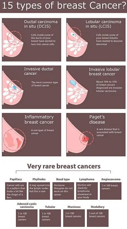 10 types of breast cancer