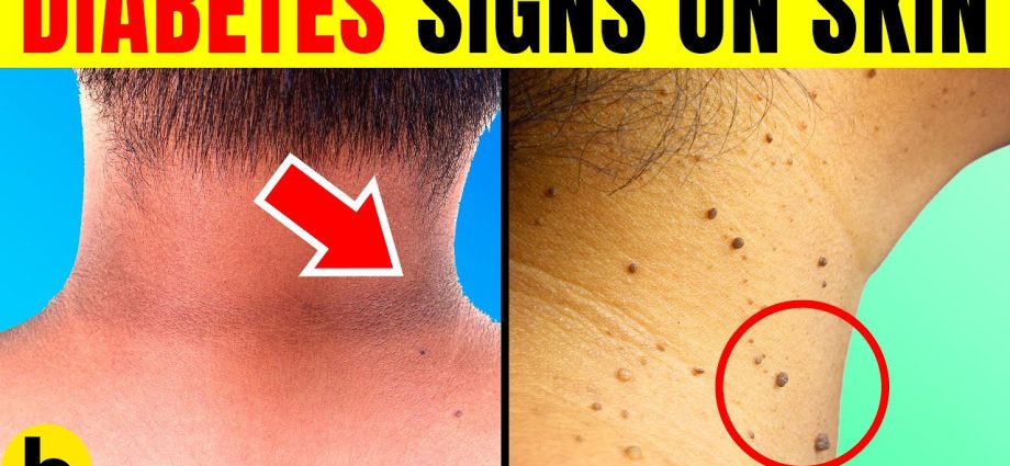 12 alarm symptoms of diabetes visible on the skin. This foreshadows problems