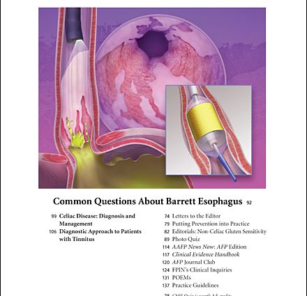 3 questions about Barrett&#8217;s esophagus