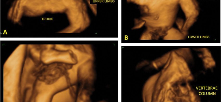 4D ultrasound in the assessment of the fetus. When to perform 4D ultrasound?