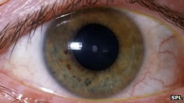 A blood test diagnoses a congenital cataract