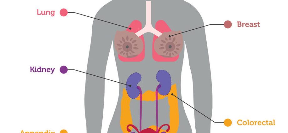 A blood test to predict whether the cancer will spread