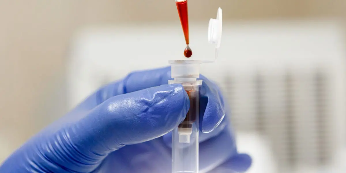 A blood test will show if cancer treatment is working. Result in 24 hours