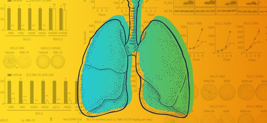 A breakthrough in the treatment of lung cancer. Scientists know how to stop disease