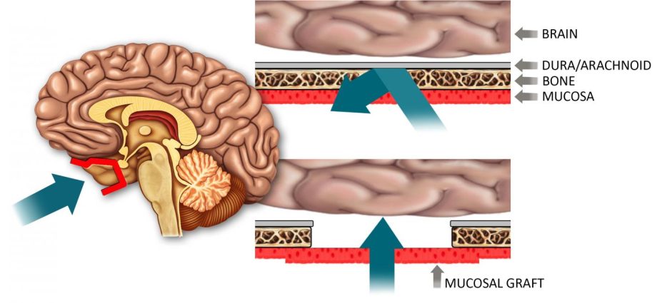 A breakthrough method of delivering drugs to the central nervous system