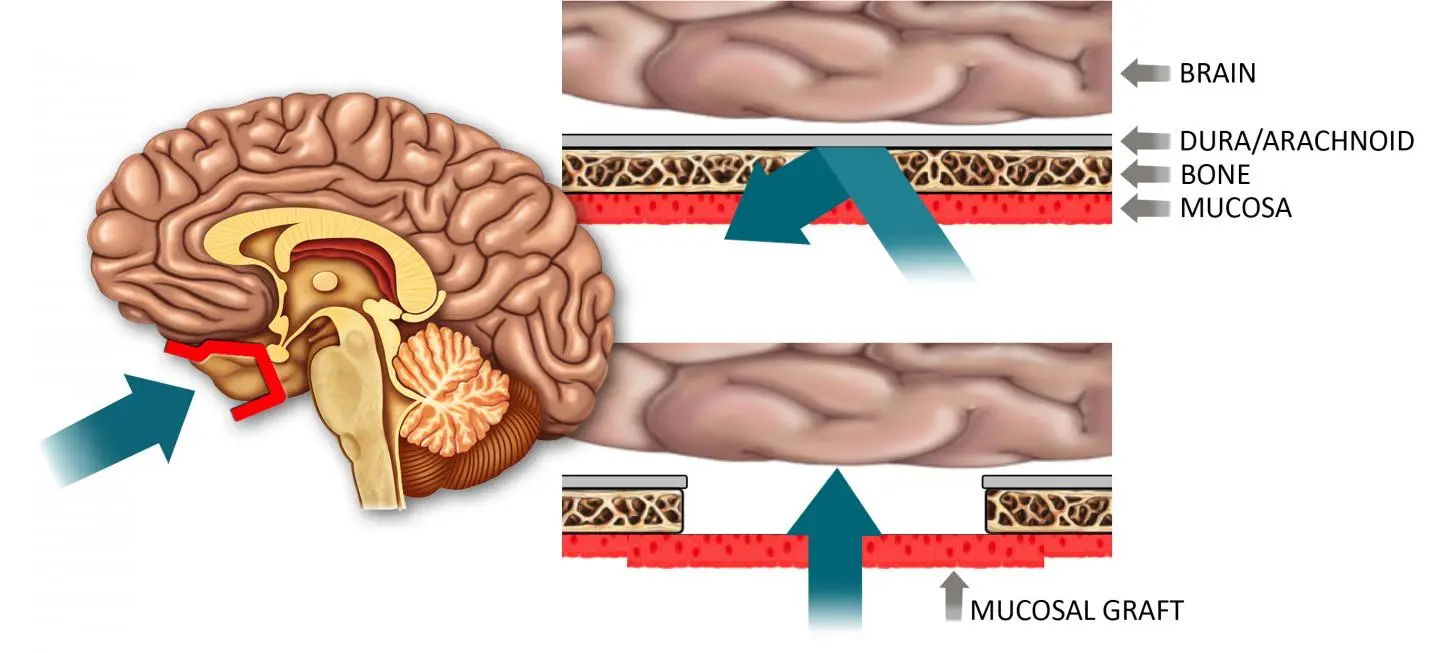 A breakthrough method of delivering drugs to the central nervous system