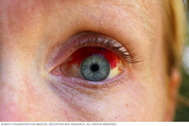 A broken capillary in the eye &#8211; symptoms, causes, treatment. What is a subconjunctival hemorrhage?