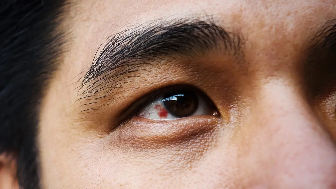 A broken line in the eye &#8211; what can it show? What to do with a broken eye vein?