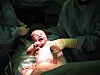 A caesarean section gives the baby a different bacterial flora