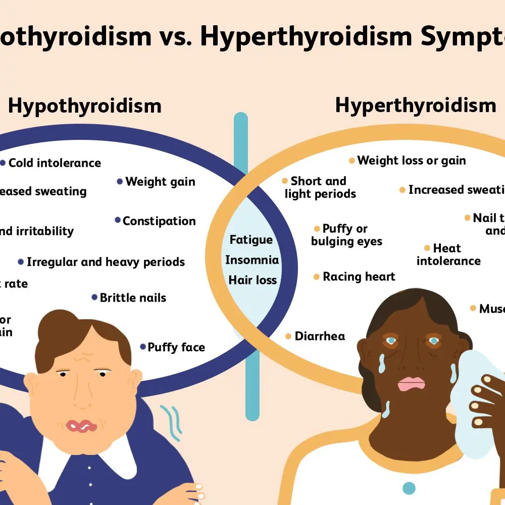 A characteristic sign that the thyroid gland is malfunctioning. It appears in the eyes