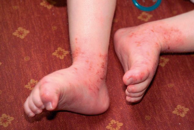 A child&#8217;s stay in a nursery may cause eczema