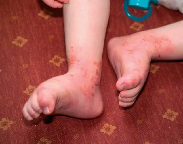 A child&#8217;s stay in a nursery may cause eczema